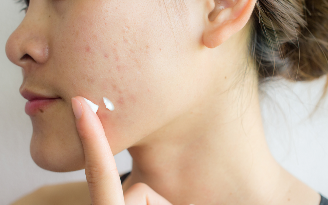 How a Food Intolerance Test Could Clear Up Your Acne