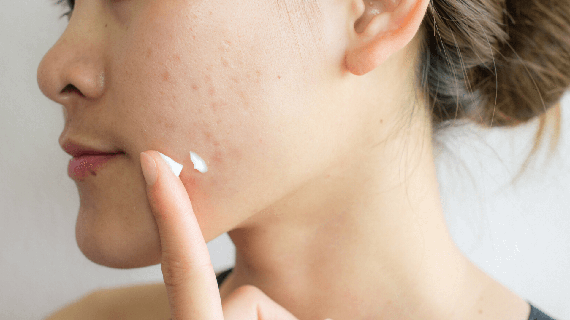 can a food intolerance test help with acne?